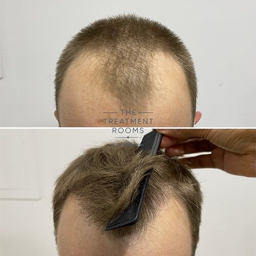 1756 grafts result- The Treatment Rooms London photo