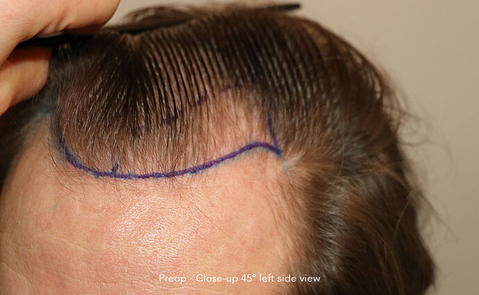 Case performed by Dr. Feriduni – 3322 FU in 1 procedure photo
