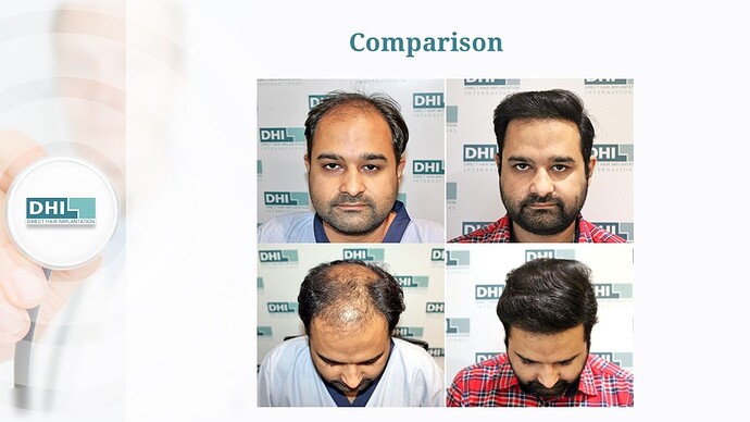 Full Scalp Coverage – 3,636 Grafts | DHI India Result photo