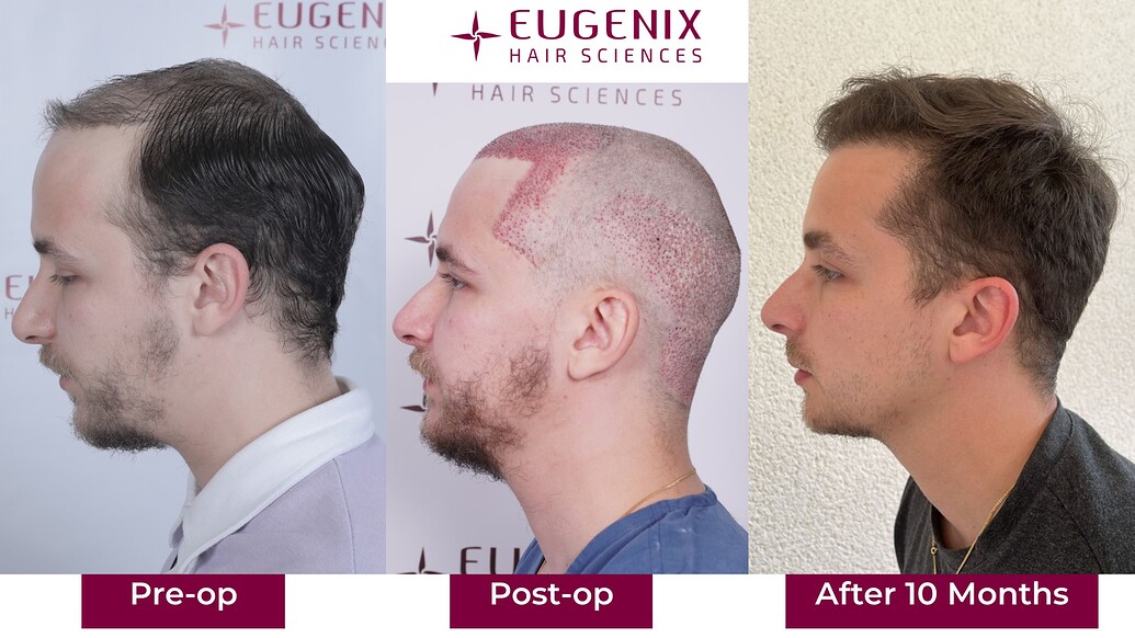 https://cdn.forumhairtransplant.com/optimized/3X/2/f/2f06f22a3e5d8759d062e8a8f058a64806ff5d86_2_1035x582.jpeg