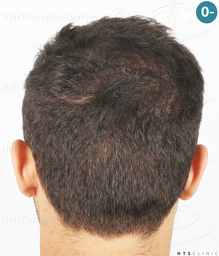 Dr Devroye + Dr Montesanti + Dr Jenard, HTS Clinic / 2018 FUE / Hairline & frontal area photo