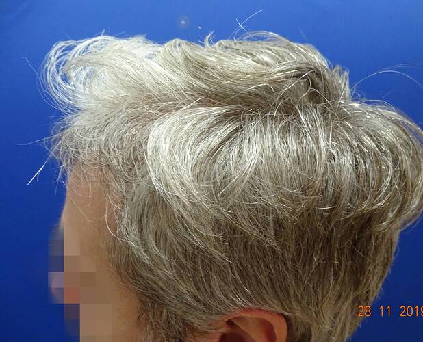 Dr. Bisanga - BHR Clinic - 2180 FUE Repair 0 - 17 Months - Graft Removal and Hairline Reconstruction photo