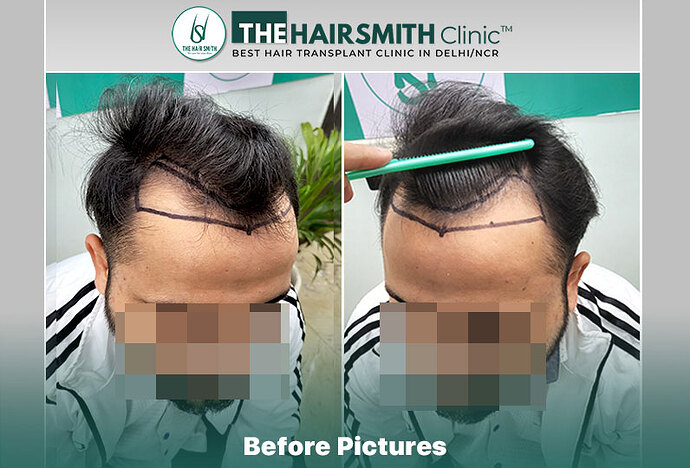 The HairSmith Clinic™ | NW Stage 3 | 1,850 Grafts | 5 Months Hair Transplant Result photo
