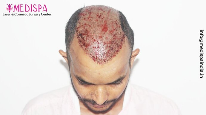 Dr. Suneet Soni - 5294 Grafts, Combine FUT + FUE + Beard Technique, NW- VI, 2 Years Result photo