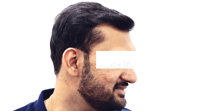 Dr. Suneet Soni - 4665 Grafts, Combine FUT + FUE + BHT (Beard) Technique photo