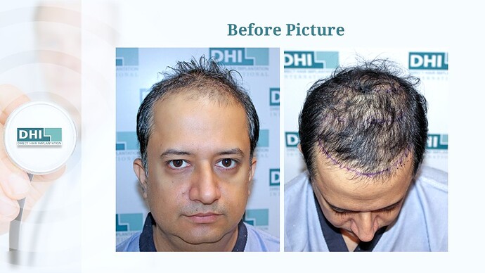 DHI India™ | NW 5 | 3,323 Grafts | 1 Year Hair Transplant Result photo