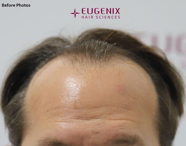 EUGENIX HAIR SCIENCE - DR. PRADEEP SETHI - A PERFECT USE OF 3287 GRAFTS photo