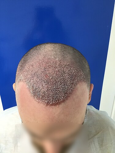 Dr. Kostis BHR Clinic Brussels - 2950 FUE 0 - 5 Months photo