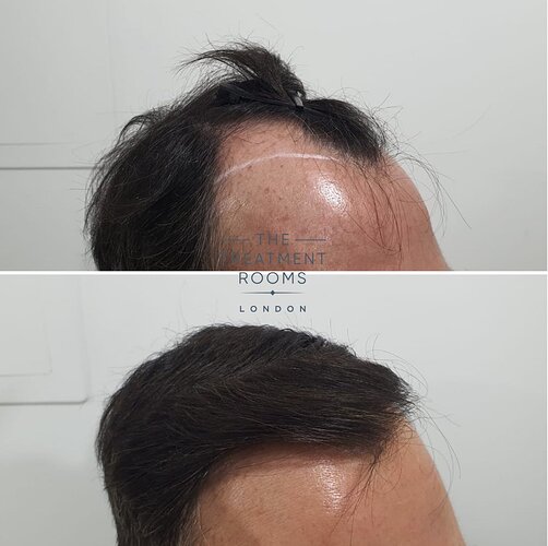 1800 Grafts Hairline, Temples and Crown FUE Hair Transplant photo