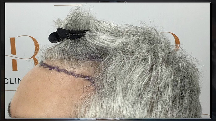 Dr.Bisanga, BHR CLINIC, 2553 FUE 0 - 7.5 MONTHS photo