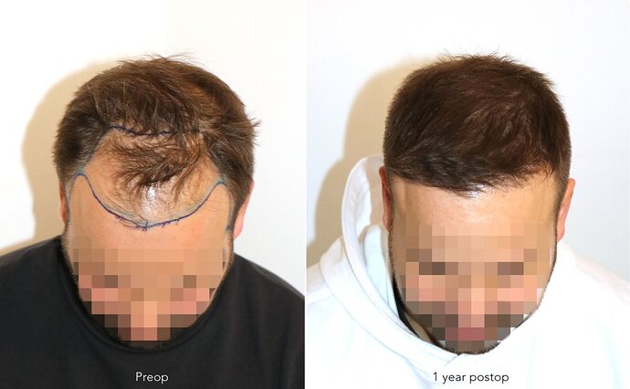 Case performed by Dr. Feriduni – 3726 FU in 1 procedure photo