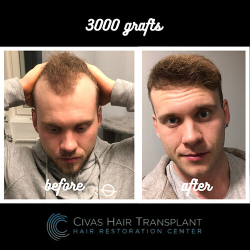 Civas Hair Transplant, 3000 graft, FUE photo