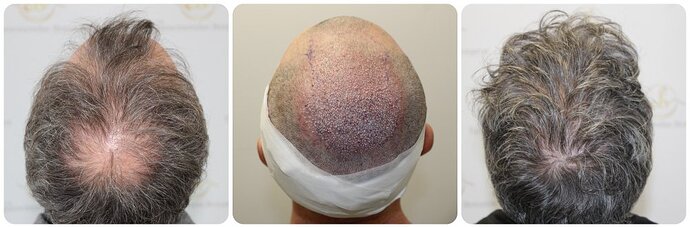 Dr Bonaros, Glasgow, UK / 3595 FUE grafts / 0-12 Months photo