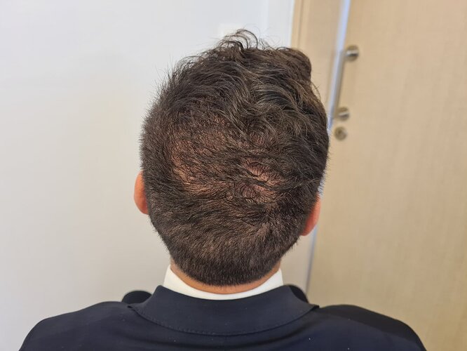 Crown Result of 3rd FUE for 2410 Grafts – HDC Hair Clinic photo