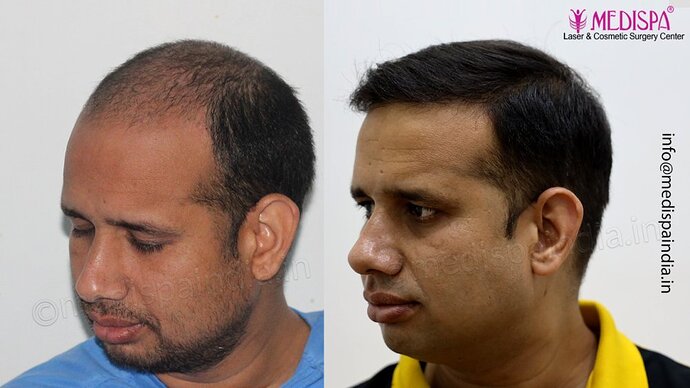 Dr. Suneet Soni - 4500 Grafts, Combine FUT + FUE Technique, NW-III photo