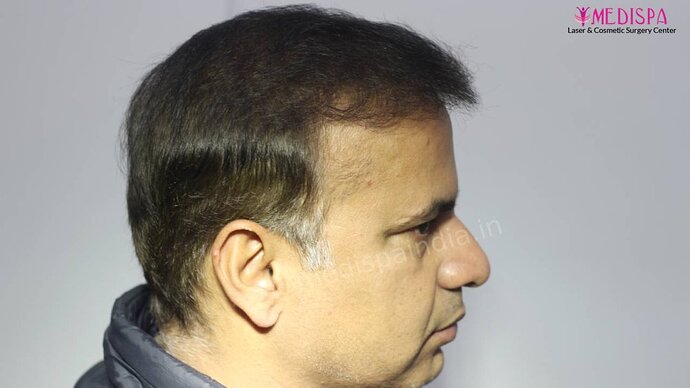 11600 Grafts in 3 FUT Sittings by Dr Suneet Soni photo