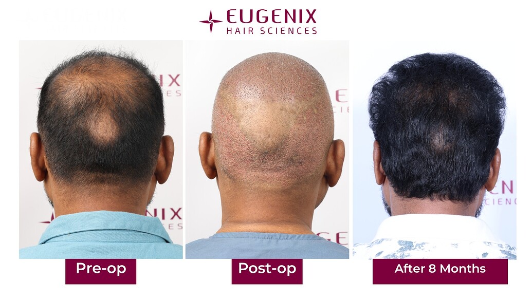 https://cdn.forumhairtransplant.com/optimized/3X/3/1/317f26d3fcdefa784b84bf82081546c5caf3af18_2_1035x582.jpeg