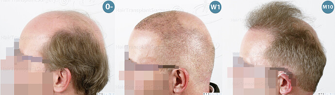 Dr. Jean Devroye, HTS Clinic / 6494 FUE-BHT (3150 + 3344) / NW VII, 2 sessions photo