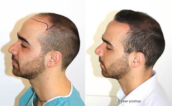Case performed by Dr. Feriduni – 3505 FU in 1 procedure photo