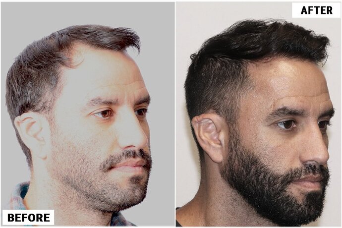 Dr. John Cole - Forhair Clnic Atlanta - FUE 2930 grafts Results photo