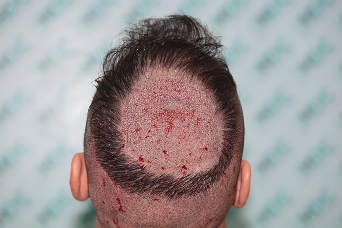 Crown Result of 3rd FUE for 2410 Grafts – HDC Hair Clinic photo