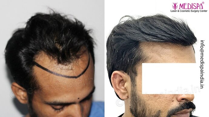 Dr. Suneet Soni - 3029 FUE Grafts, FUE Method (Trivellini System), NW - III photo