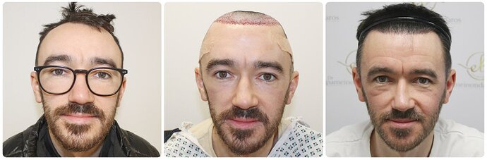 Dr Bonaros, Glasgow, UK / 1816 FUE grafts / 0-12 Months photo