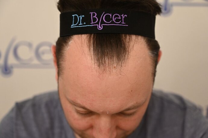 Ozlem Bicer MD-Hair Transplant-2910 Grafts FUE by micro-motor, 7. months result photo