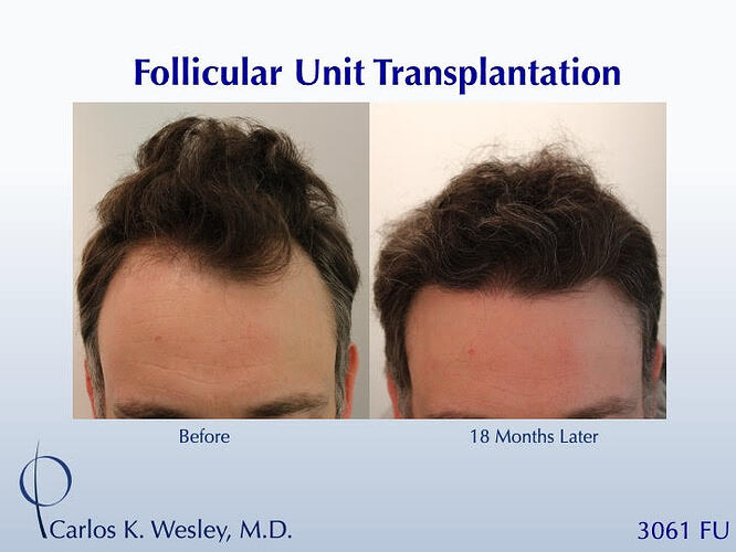 #BAM Natural Flow to a Hairline (3061 grafts): Carlos K. Wesley, M.D. (NYC & LA) photo