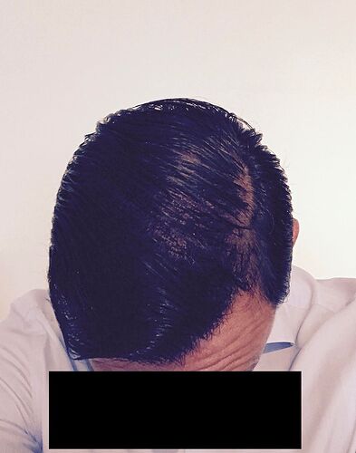 DR HAKAN DOGANAY/4055 GRAFTS/FUE+Implanter Pen photo