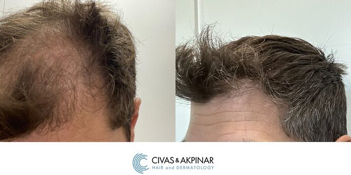 Civas&Akpınar Hair Transplant- FUE Hair Transplant Before & After Pictures (3200 Grafts) photo