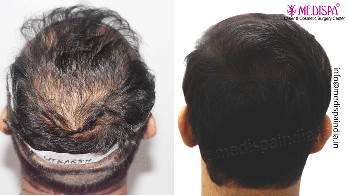 Dr. Suneet Soni - 4665 Grafts, Combine FUT + FUE + BHT (Beard) Technique photo