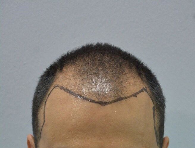 DR HAKAN DOGANAY/ 3500 GRAFTS / After 3 Years/ Implanter Pen+FUE photo