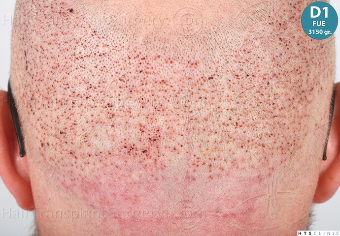 Dr. Jean Devroye, HTS Clinic / 6494 FUE-BHT (3150 + 3344) / NW VII, 2 sessions photo