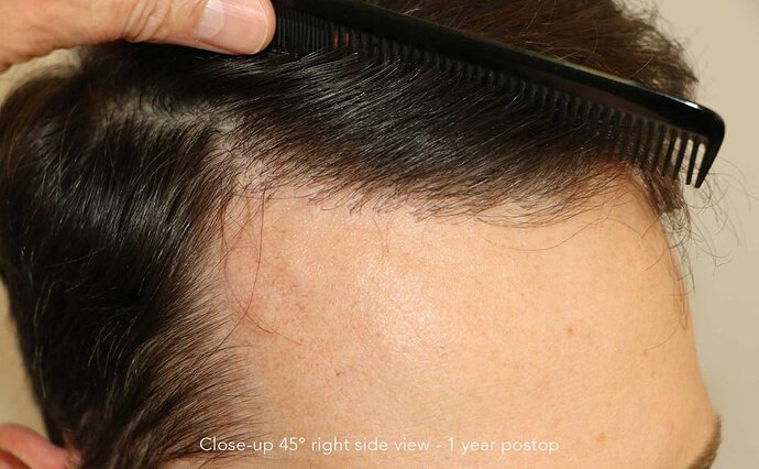 Case performed by Dr. Feriduni – 3046 FU in 1 procedure photo