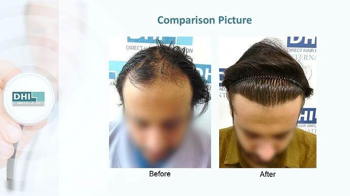 DHI India™ | NW 4 | 3,714 Grafts | 2 Years DHI Hair Transplant Result photo