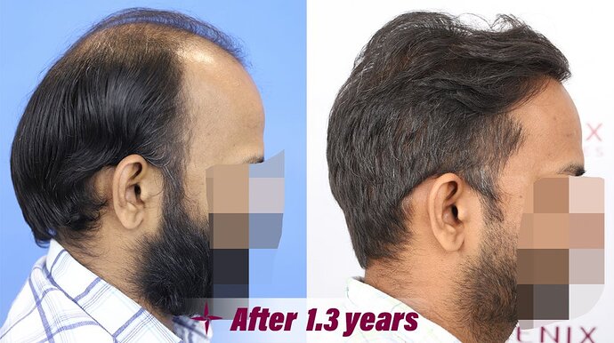 Hair Transplantation Result in 1.3 Years, 5000 Grafts, Grade 6 @Eugenix by Drs Sethi & Bansal photo