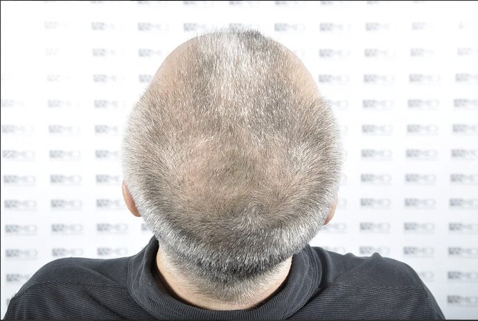 Asmed Clinic - FUE Hair Transplant - 5041 Grafts photo