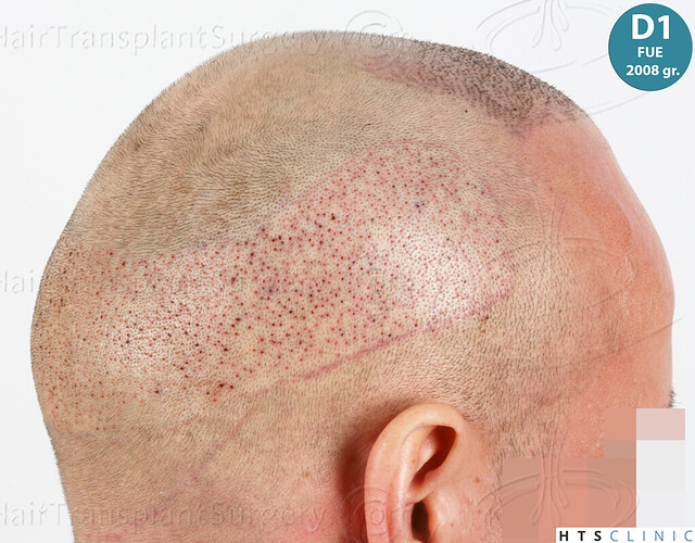 Dr. Jean Devroye, HTS Clinic / 5280 FUE (2008 + 2018 + 1254) / 3 sessions photo