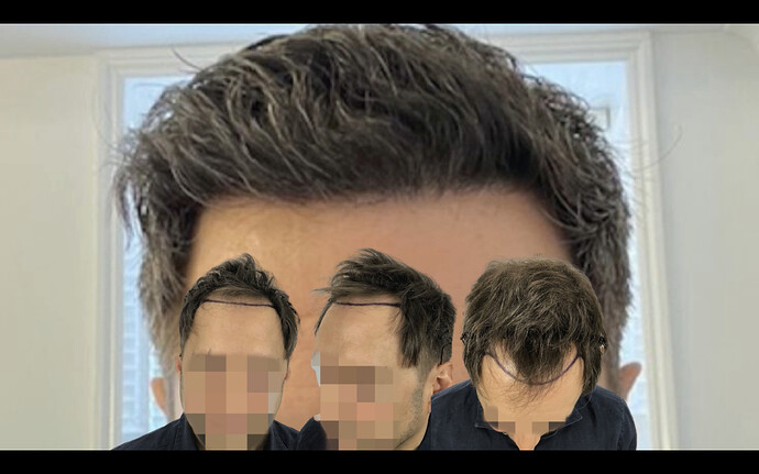Dr. Bisanga & Dr.Kostis 2903 FUE 0 - 6 Months photo