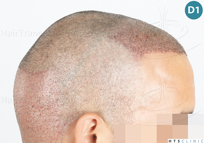 Dr Devroye + Dr Montesanti + Dr Jenard, HTS Clinic / 2018 FUE / Hairline & frontal area photo