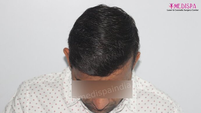 Dr. Suneet Soni - 4025 Grafts | 12-Month Result | Combination FUT + FUE photo