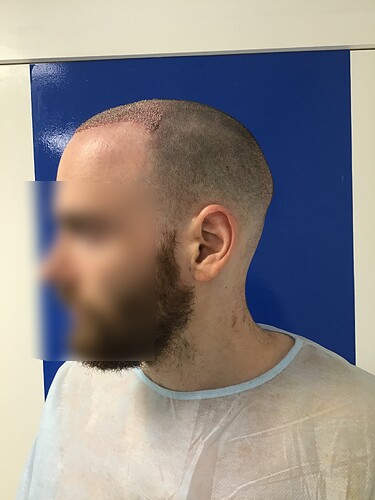Dr. Kostis BHR Clinic Brussels - 2950 FUE 0 - 5 Months photo