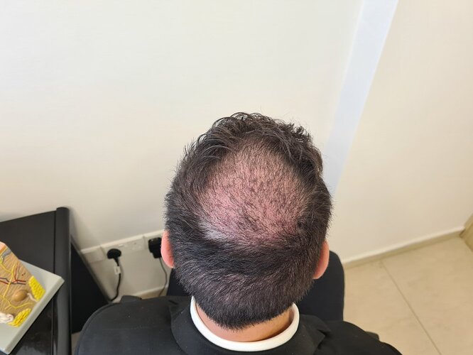 Crown Result of 3rd FUE for 2410 Grafts – HDC Hair Clinic photo