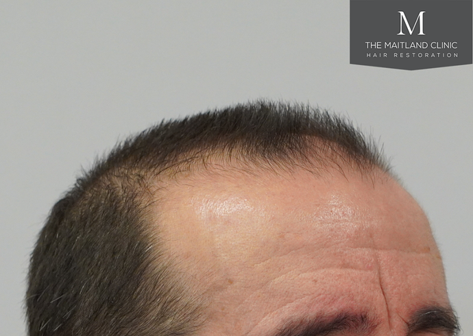 Dr Ball - The Maitland Clinic 3803 Grafts By FUT photo