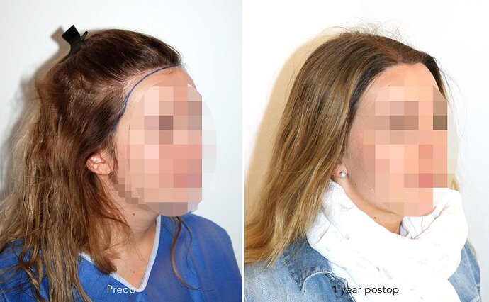 Repair case performed by Dr. Feriduni – 1865 FU in 1 procedure photo
