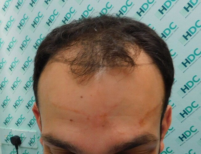 FUE Result for 3000 Grafts – NW Class 3 – Wavy hair – HDC Hair Clinic – Dr Christina photo