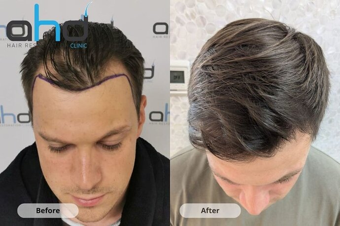 AHD Clinic / Technicians / 2250 grafts / FUE + DHI photo