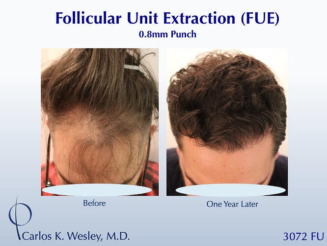 #BAM Natural-Appearing FUE Hairline Wavy Hair (3072 grafts): Carlos K. Wesley, M.D. (NYC & LA) photo