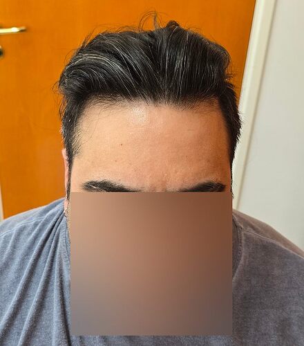Density Enhancement Result for 4516 FUE Grafts – HDC Hair Clinic – 1 Year Post-Procedure photo